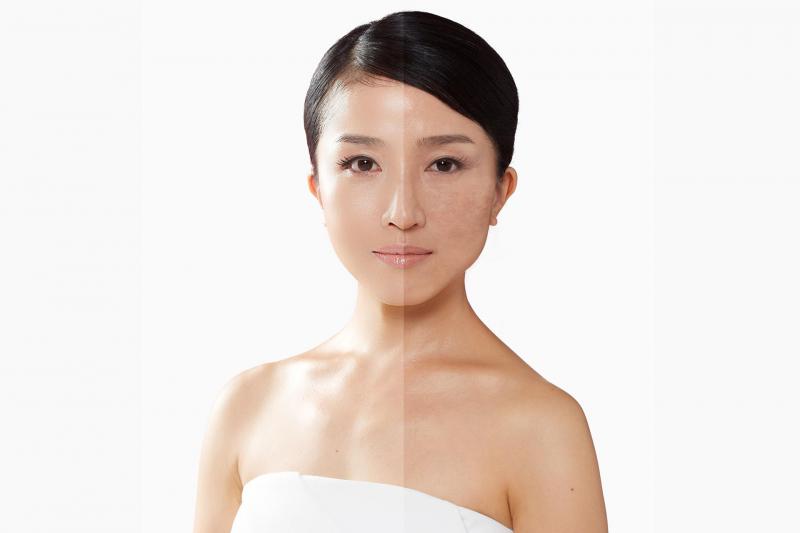 Công nghệ trị nám Laser Melasma