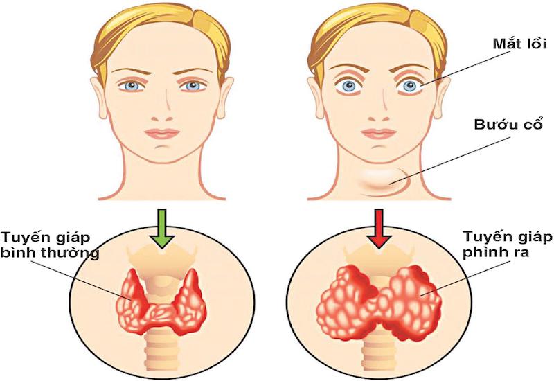 Biểu hiện bệnh cường giáp (bên phải)