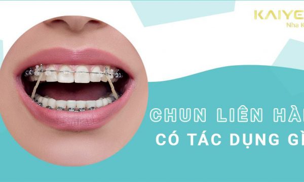 Chun liên hàm – dụng cụ hỗ trợ niềng răng hiệu quả