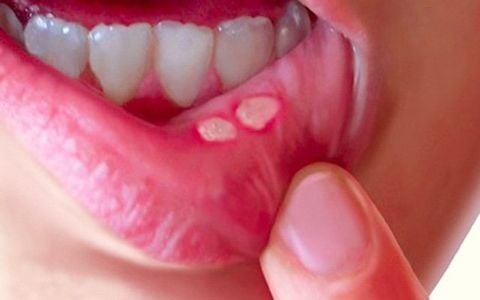 SLS trong kem đánh răng: Những điều bạn cần biết