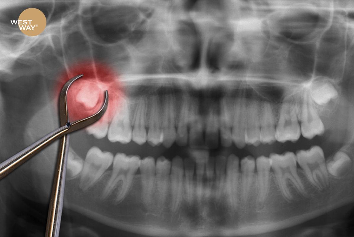 Với những răng khôn mọc bất thường, bác sĩ sẽ chỉ định nhổ bỏ để bảo vệ sức khỏe