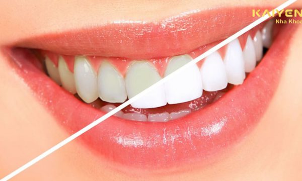 Tẩy trắng răng có bị vàng lại không? Nguyên nhân răng bị vàng lại