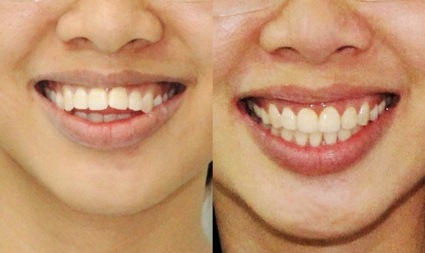 Bọc răng sứ khắc phục 2 răng cửa to và hô