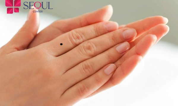 Nốt ruồi ở ngón tay – Ý nghĩa và câu trả lời có nên xóa hay không?