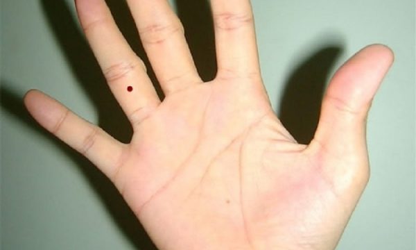 Nốt ruồi ở ngón tay: Điểm trúng phúc hay rủi ro?